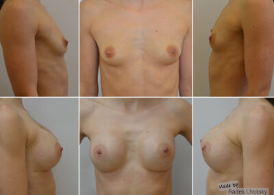 Augmentace prsou silikonovými implantáty, před/po, MUDr. Radek Lhotský