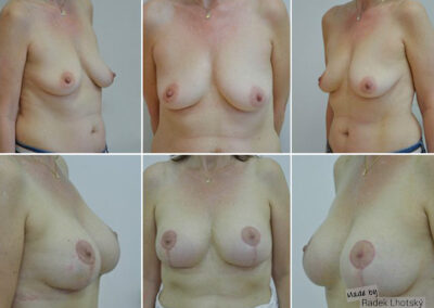 Modelace prsou s augmentací pomocí implantátu, MUDr. Radek Lhotský