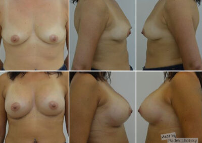 Augmentace prsou silikonovými implantáty, před/po, MUDr. Radek Lhotský