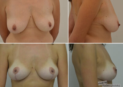 Modelace prsou po 6 měsících - před a po, MUDr. Radek Lhotský