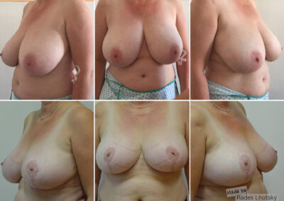 Redukce prsou - srovnání před a po - MUDr. Radek Lhotský