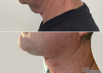 Facelift a necklift - muž, před/po, MUDr. Radek Lhotský