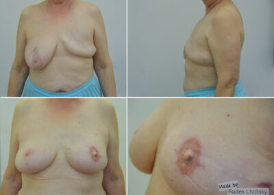 Rekonstrukce prsu - před/po srovnání