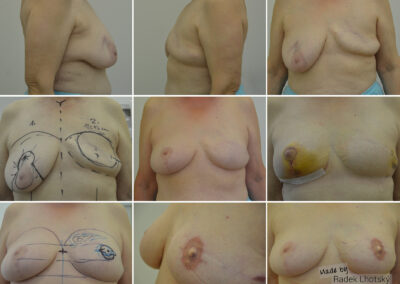 Rekonstrukce prsu v několika krocích - průběh operací - MUDr. Radek Lhotský