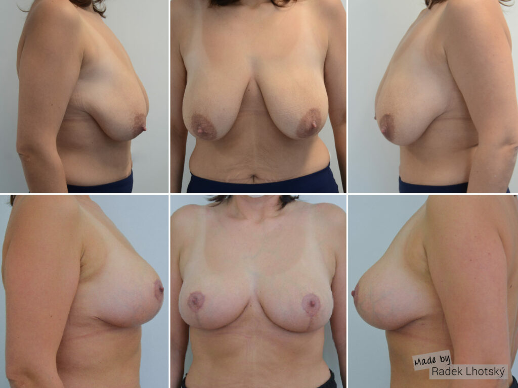 Modelace prsou - MUDr. Radek Lhotský