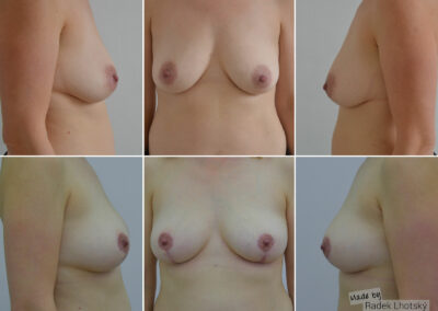Modelace prsou s augmentací, využití vlastního tuku- před/po fotografie