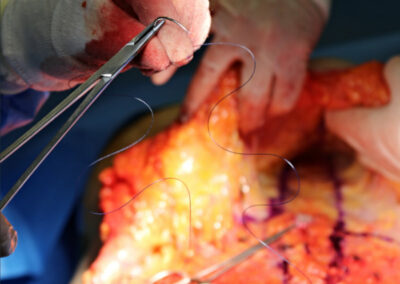 Abdominoplastika - snímek z operace, MUDr. Radek Lhotský