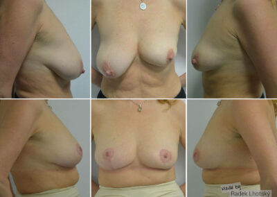 Odstranění asymetrie modelací a redukcí pravého prsu - před/po fotografie