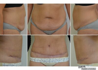 Výsledek operace abdominoplastika s liposukcí břicha a sešitím diastázy, srovnání před a po