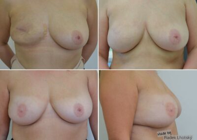 Rekonstrukce prsou hybridní metodou: vlastní tuk + implantát - před/po fotografie