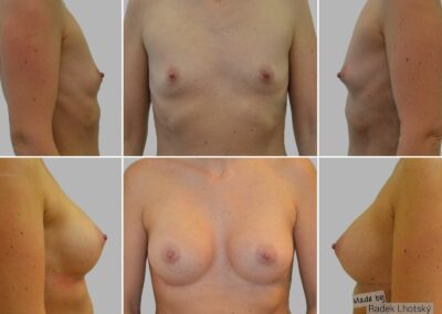 Augmentace prsou s anatomickými implantáty - před/po fotografie