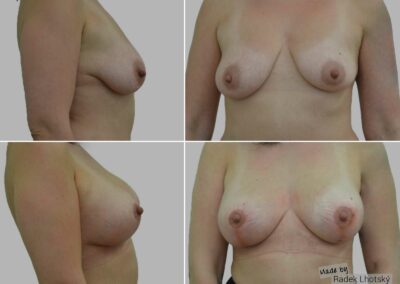 Modelace prsou s augmentací - před/po srovnání