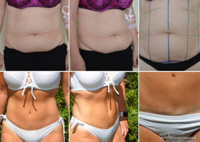 Výsledek operace abdominoplastika s liposukcí břicha a sešitím diastázy, před a po fotografie