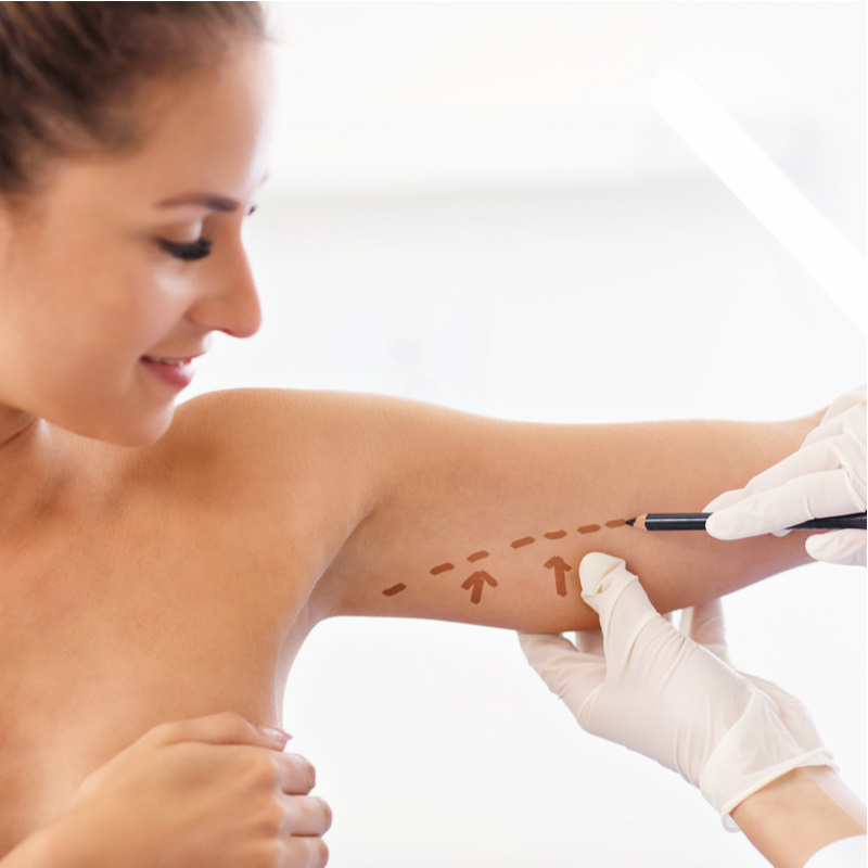 Plastická operace paží, brachioplastika - ilustrační obrázek