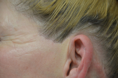 Jizva před uchem po faceliftingu - Dr. Radek Lhotský