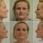 Deep plane facelift, před a po fotografie, MUDr. Radek Lhotský