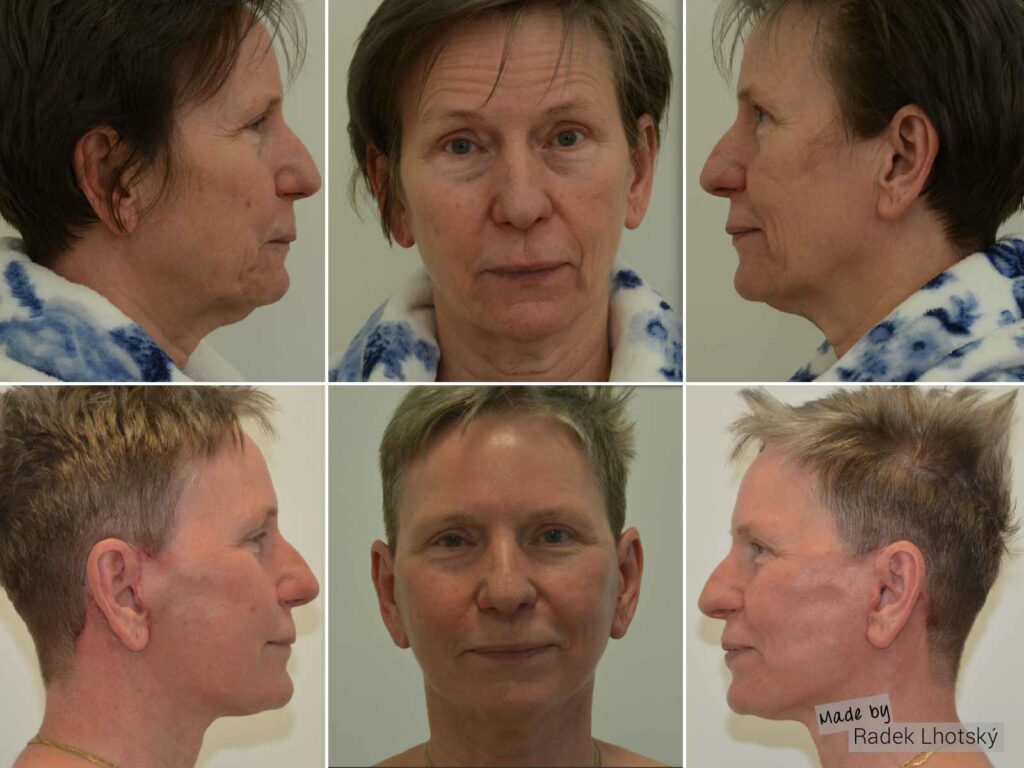 Deep plane facelift - fotografie pacientky před a po - MUDr. Radek Lhotský