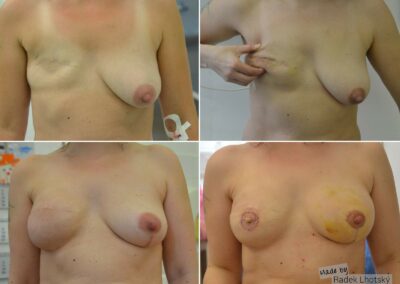 Rekonstrukce prsu - před / po fotografie