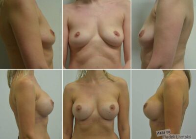 Fotografie před a po operaci zvětšení prsou, augmentace, pomocí implantátu, 345 ml, pod sval - MUDr. Radek Lhotský