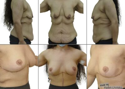 Před a po fotografie - bodylift po masivní redukci váhy - plastika břicha a prsou