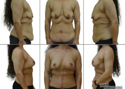 Před a po fotografie - bodylift po masivní redukci váhy - plastika břicha a prsou
