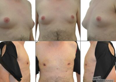 Před a po fotografie operace gynekomastie - zmenšení mužských prsou