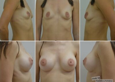 Před a po fotografie - augmentace pomocí silikonových prsních implantátů, MUDr. Radek Lhotský