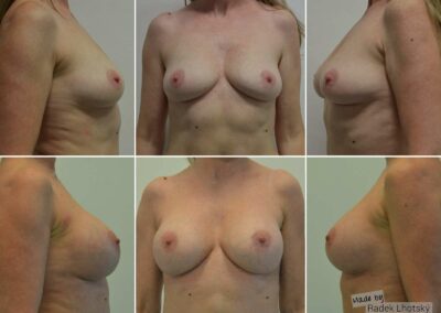 Před a po fotografie augmentace, zvětšení prsou, zpředu a ze strany