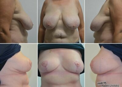 Před a po fotografie redukce prsou, zpředu a ze strany