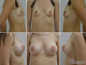 Zvětšení prsou pomocí anatomických implantátů