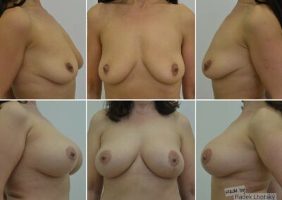 Výsledek modelace prsou s augmentací, implantáty 260 cc, 4 roky po operaci - MUDr. Radek Lhotský, plastický chirurg