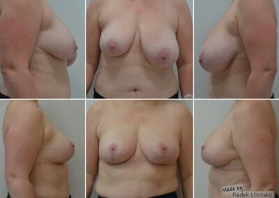 Redukce prsou s modelací, korekce velké asymetrie - před / po fotografie MUDr. Radek Lhotský