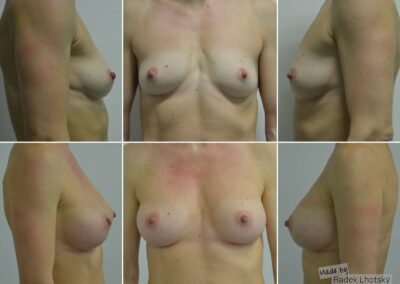 Před a po fotografie zvětšení prsou, anatomický implantát 330 cc