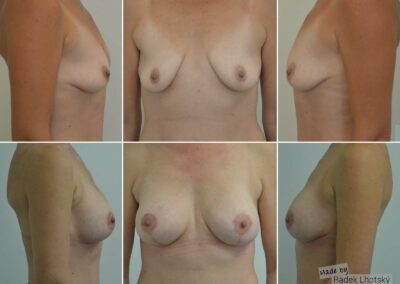 Modelace prsou se zvětšením implantáty, kulaté implantáty - před a po fotografie MUDr. Radek Lhotský