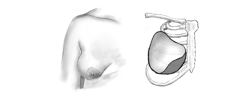 Porušený vývoj dolní vnitřní části prsu - tubulární prsa
