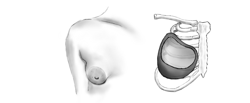 Nevyvinutá tkáň dolní části prsu u tubulárních prsou