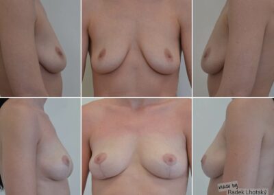 Breastlift with fatgrafting for more volume - before after pictures, Dr. Radek Lhotsky