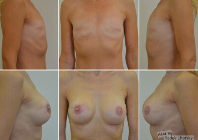 Rekonstrukce prsou, anatomický implantát - před a po fotografie, MUDr. Radek Lhotský