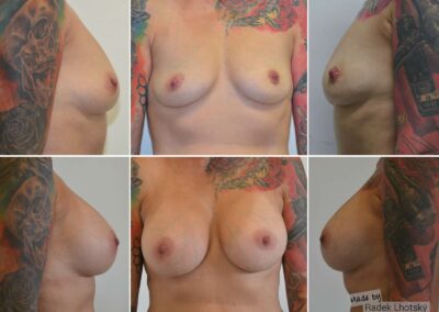 Before after picture - Breast augmentation, anatomic implant, 330 cc, Dual Plane, Dr. Radek Lhotsky