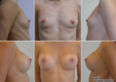 Ergebnisbeispiel - Brustvergrößerung, anatomischer Implantat 345 cc - Dr. Radek Lhotsky
