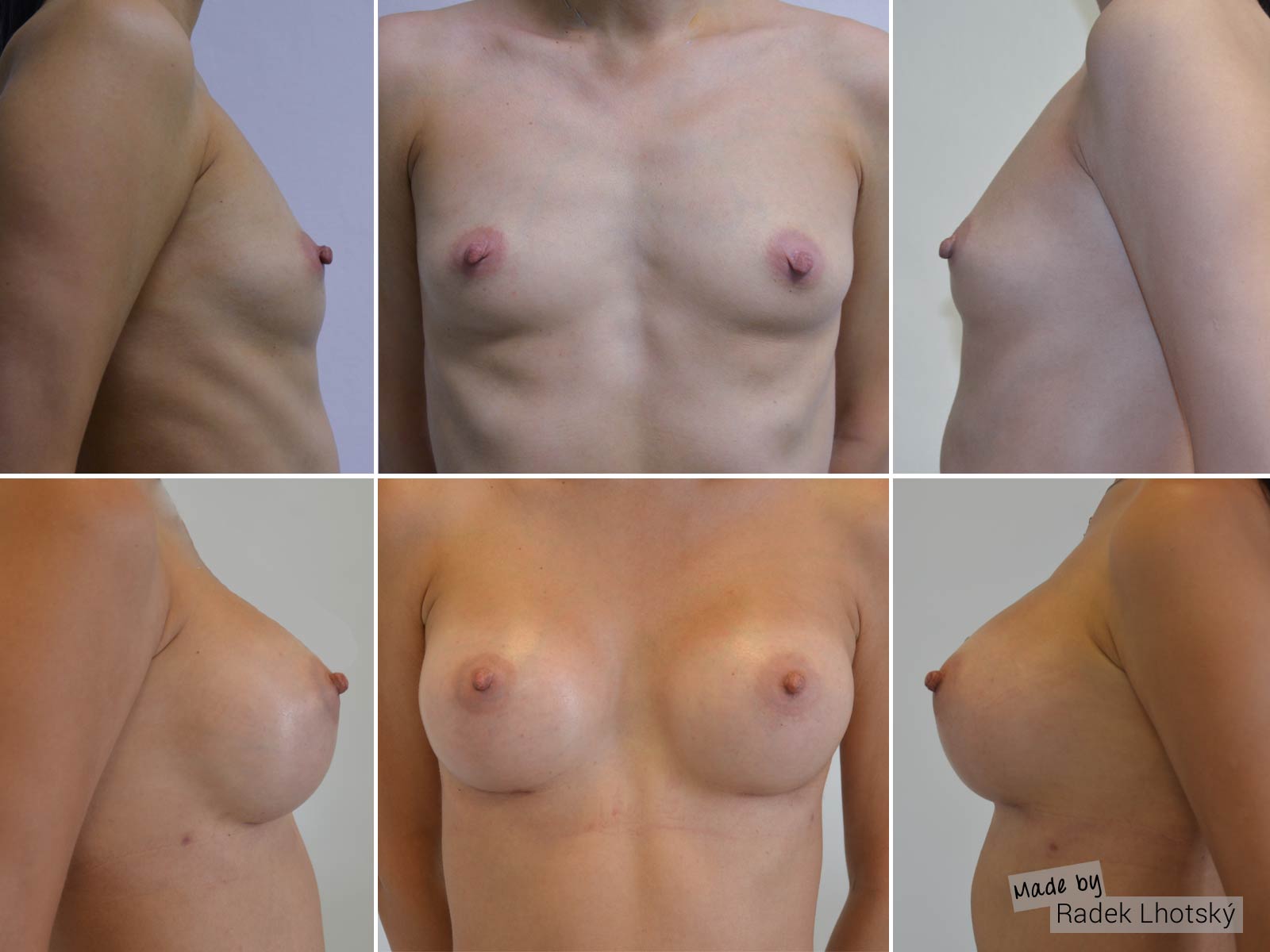 Before after picture - Breast augmentation, anatomic implant, 345 cc, Dr. Radek Lhostky