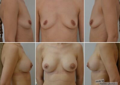 Ergebnisbeispiel - Brustvergrößerung, anatomischer Implantat, 330 cc - Dr. Radek Lhotsky