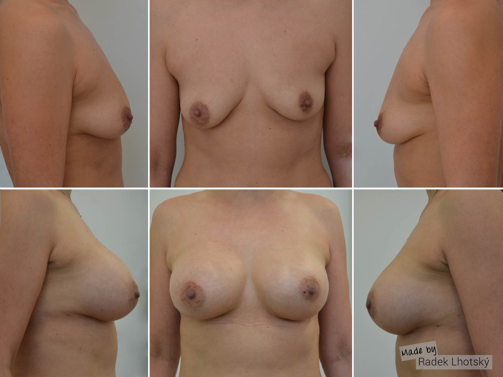 Surgery for breast asymmetry correction - before after picture, Dr. Radek Lhotsky