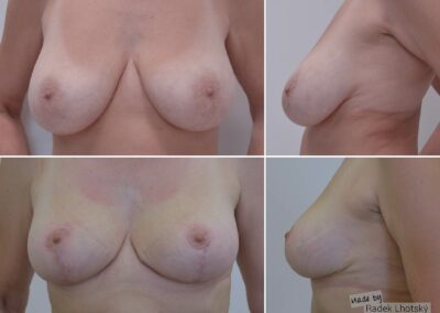 Before after picture - breast reduction, Dr. Radek Lhotsky