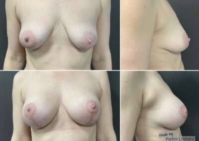 Breast lift with enlargement, before after picture - Dr. Radek Lhotsky