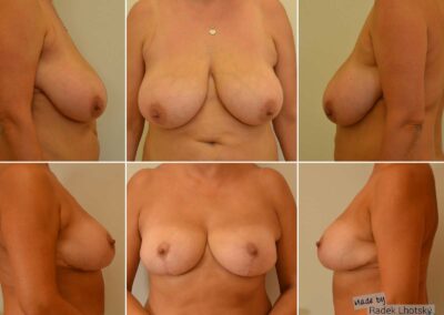 Před a po fotografie redukce prsou - MUDr. Radek Lhotský