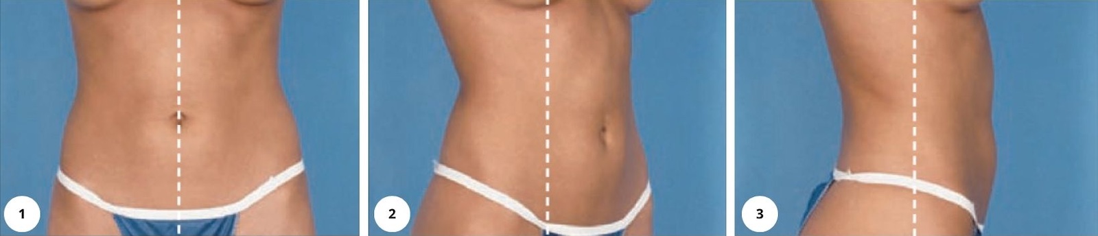Instrukce pro vytvoření fotografií pro online konzultaci - břicho a body contouring
