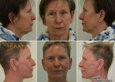 Vorher und Nachher-Bilder einer Patientin nach Deep Plane Facelift
