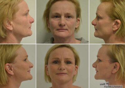Deep Plane Facelift before after pictures, Dr Radek Lhotsky