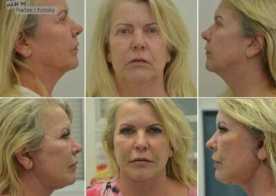 Vorher und Nachher-Bilder einer Patientin nach Deep Plane Facelift